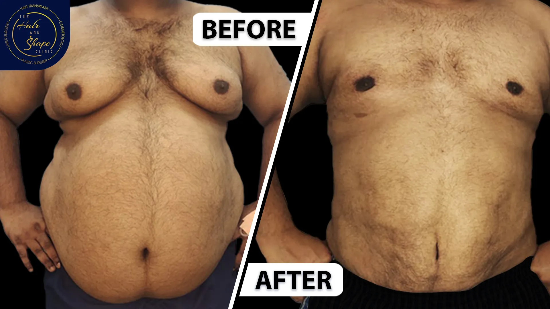 Tummy Liposuction result7
